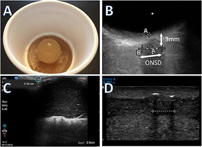 Accuracy of Optic Nerve Sheath Diameter Measurements in Pocket-Sized Ultrasound Devices in a Simulation Model